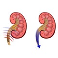 Removal of kidney stones by ultrasound.